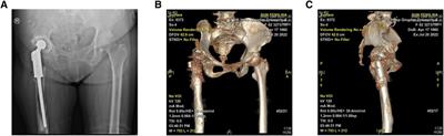 Artificial intelligence planning and 3D printing augmented modules in the treatment of a complicated hip joint revision: a case report